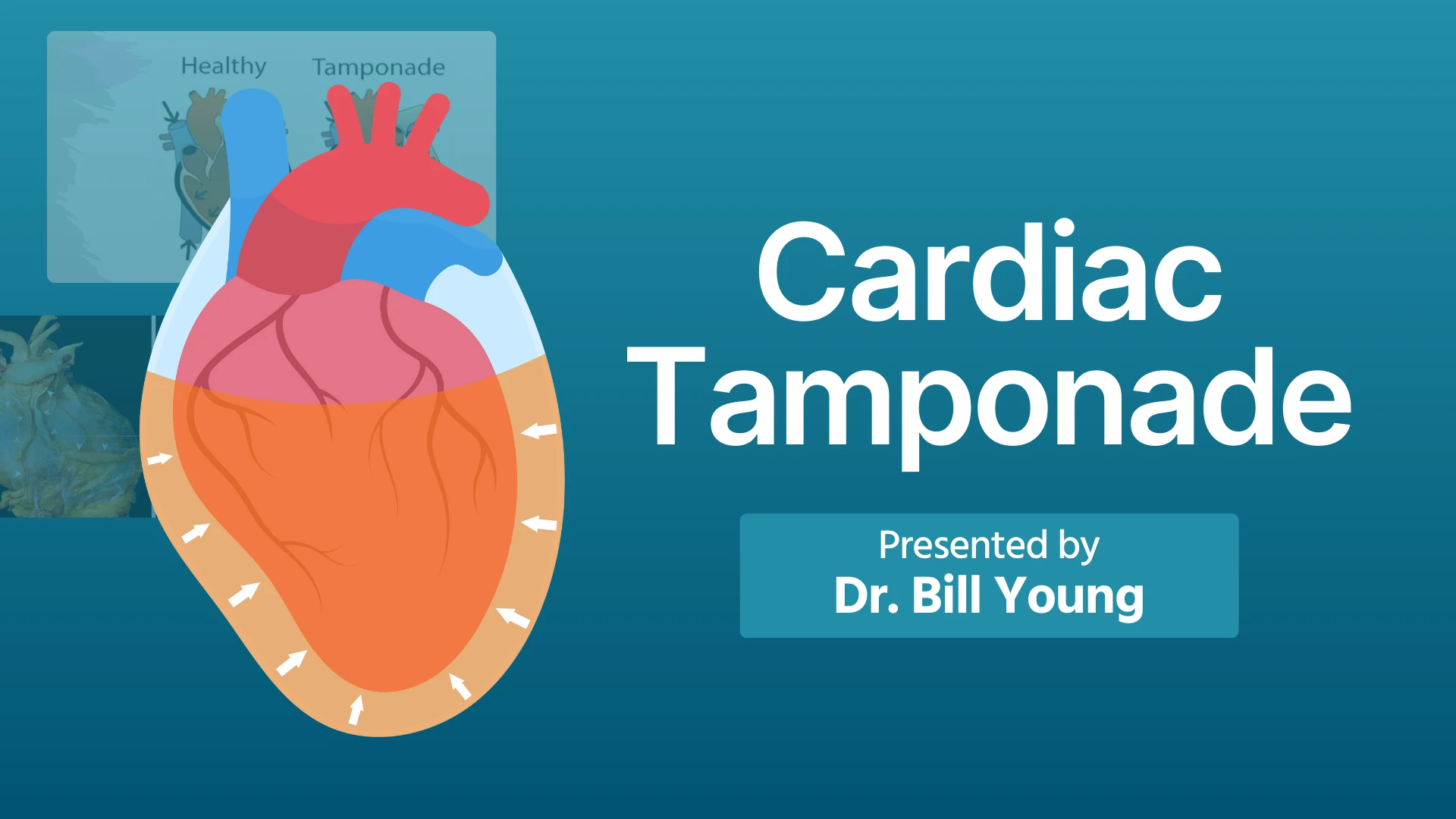 Pericardial Tamponade: The Squeeze That Kills Thumbnail